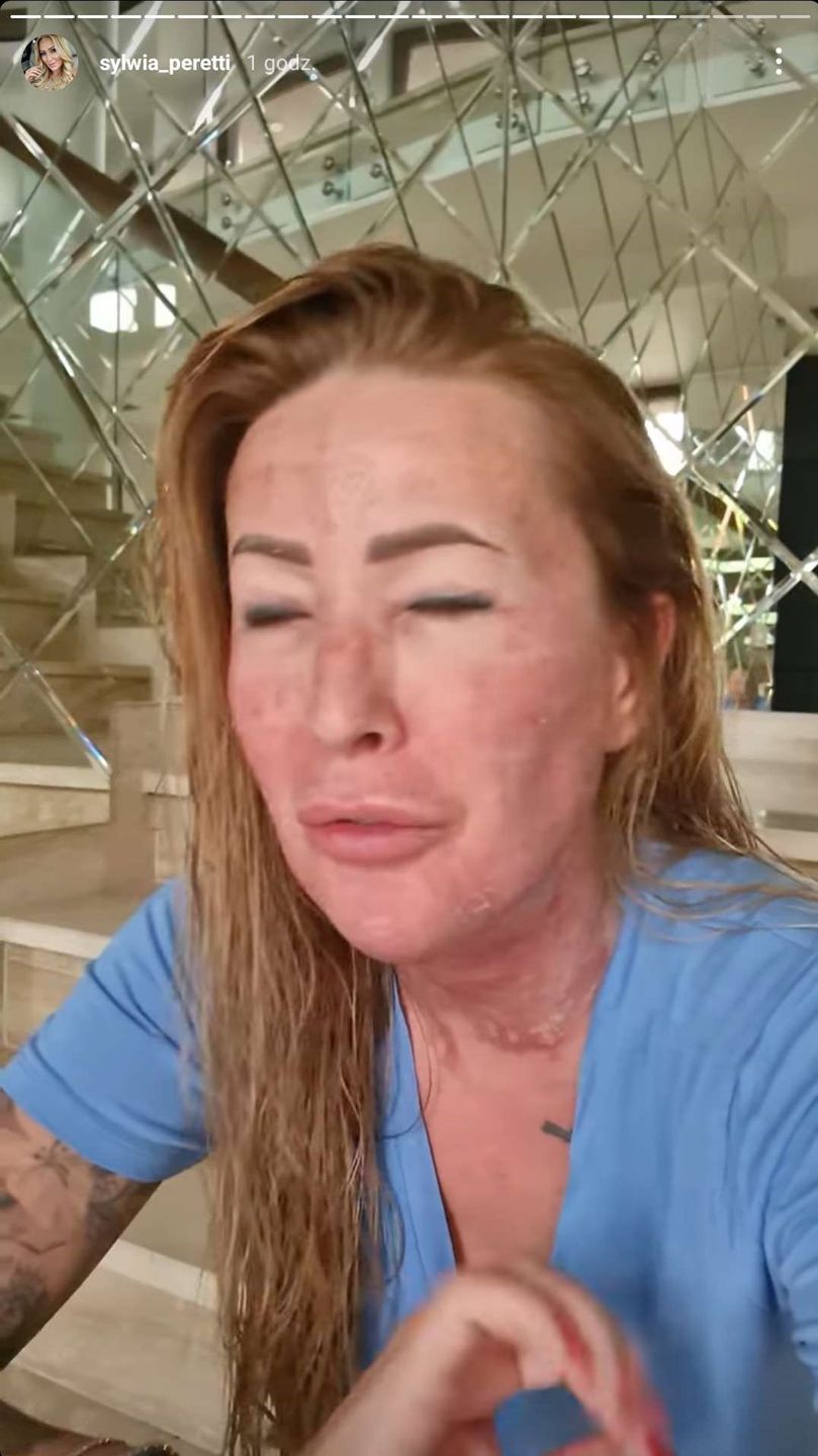 Sylwia Peretti pokazuje kolejny etap po zabiegu laserowym. Jest lepiej? 
