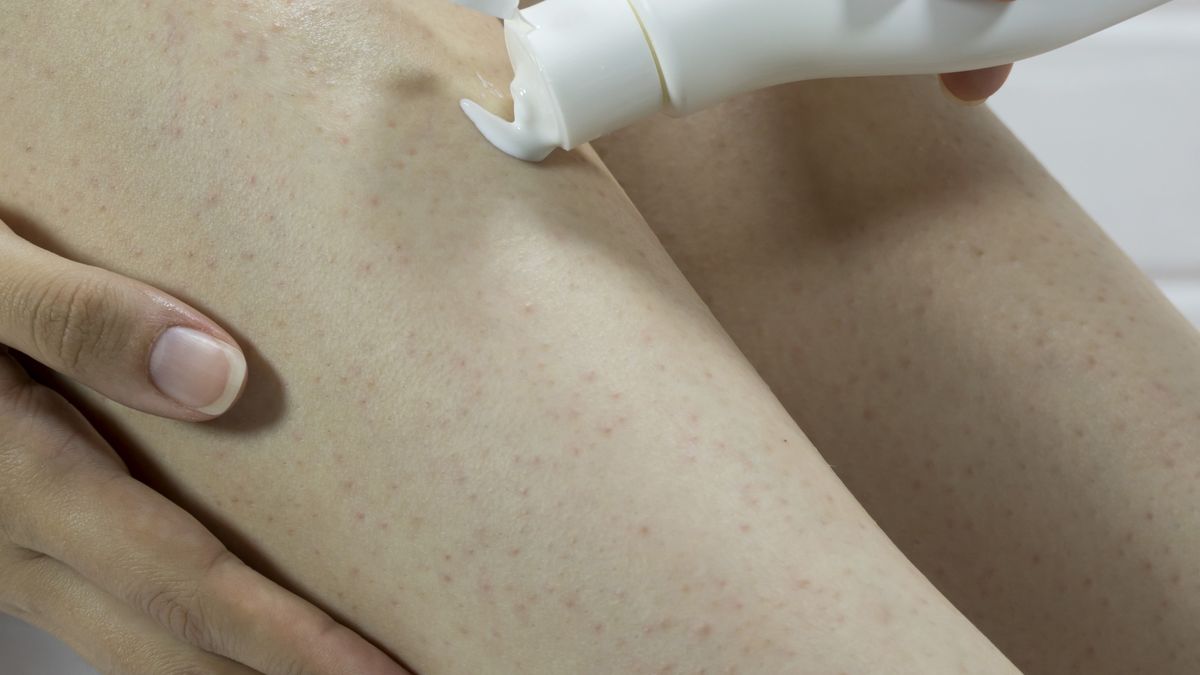 Jak uniknąć krostek po goleniu? 