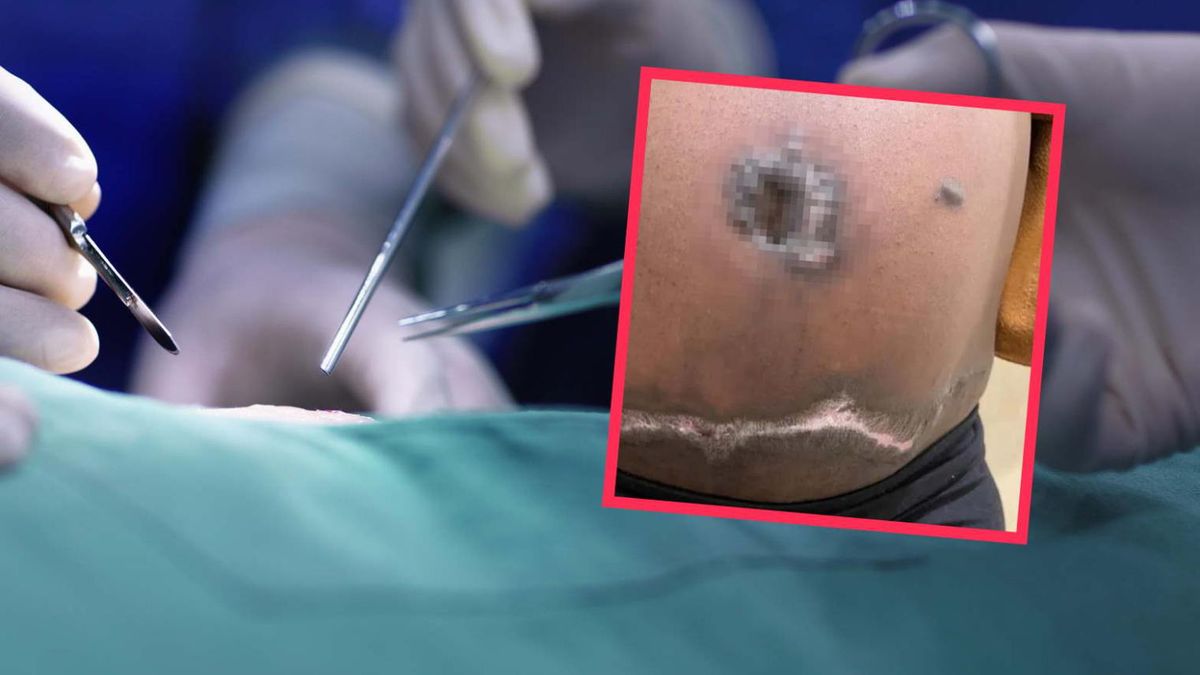 Doszło do martwicy skóry. Lekarka nie miała sobie nic do zarzucenia