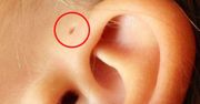 Dziurka nad uchem. Tylko 1% ludzi należy do tego wyjątkowego grona