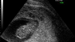 Płód w 9 tygodniu ciąży (zdjęcia)