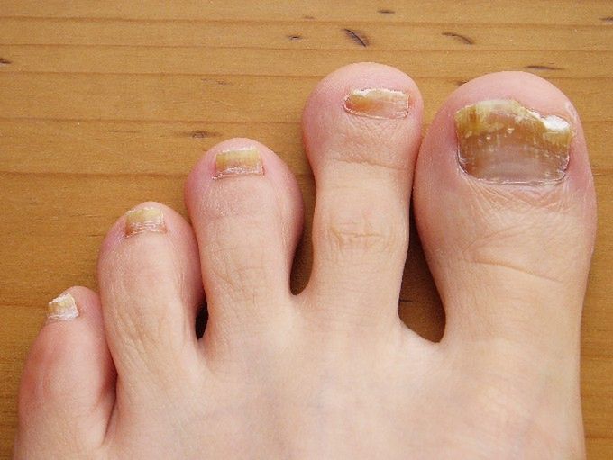 Chory na grzybicę paznokcia