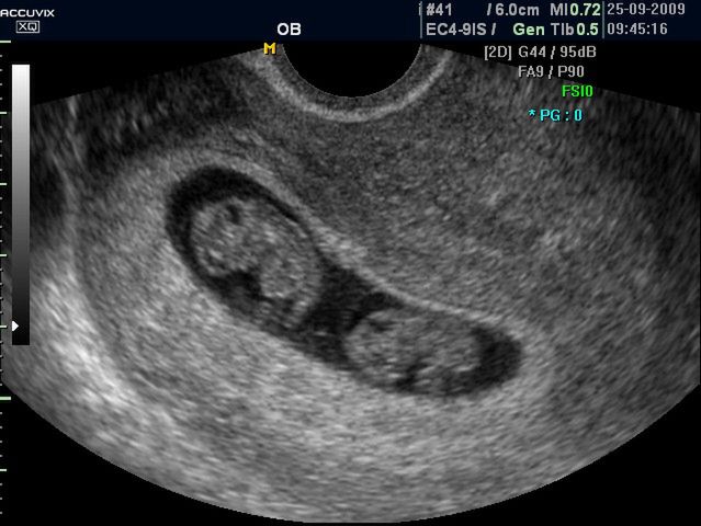 Płód w 9 tygodniu ciąży (bliźniaki jednokosmówkowe) - wielkość płodu 