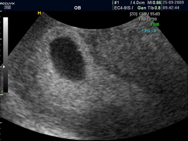 Płód w 9 tygodniu ciąży (bliźniaki jednokosmówkowe) - obraz USG 
