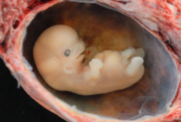 Przekrój embriona po poronieniu 