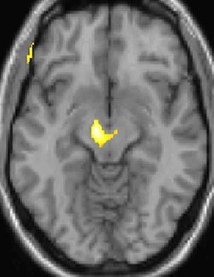 Obraz tomograficzny, na którym widać klasterowy ból głowy 