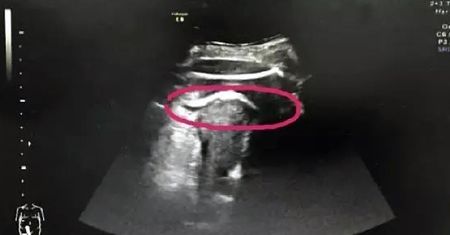 Awaryjne cesarskie cięcie po niezwykłym wypadku. "Noga dziecka przebiła macicę"