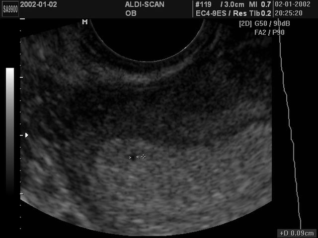 Płód w 4 tygodniu ciąży