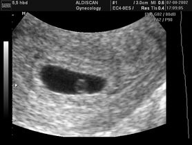 Płód w 5 tygodniu ciąży 