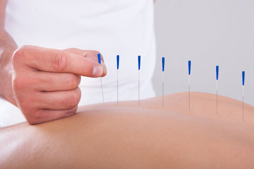Akupunktura w ciąży to technika z zakresu medycyny naturalnej, która pozwala zniwelować bóle kręgosłupa.