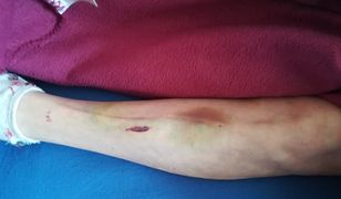 79-letnia kobieta miała zostać pobita przez opiekunkę. "Zrobiła z mojej mamy kalekę"