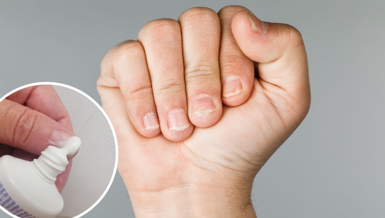 Domowy sposób na częsty problem paznokci! Pomoże produkt z łazienki