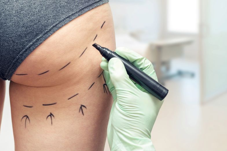 plastic surgeon marking womans body for plastic surgery