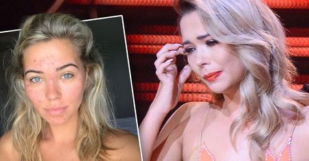 Sandra Kubicka pokazała oszpeconą chorobą twarz: "Nie życzę tego nikomu". Odważne zdjęcie