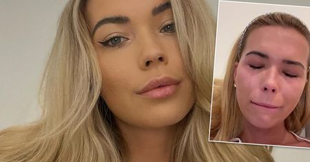 Sandra Kubicka pokazała obrażenia po sylwestrze. Auć! A twierdziła, że siedziała przed telewizorem...