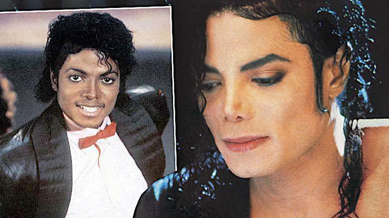 Michael Jackson choroba bielactwo