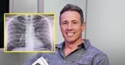 Chris Cuomo, dziennikarz CNN pokazał rentgen swoich płuc. Jest zakażony koronawirusem