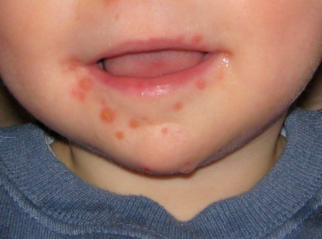 Wysypki u dziecka mogą mieć charakter punktowych, białych lub czerwonych plam