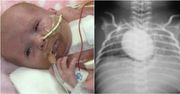 Dziecko urodziło się z sercem poza klatką piersiową. Lekarze dokonali cudu