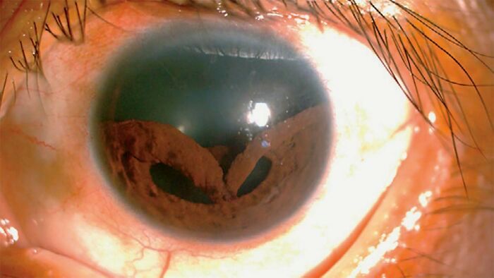 Eye injury causes man's iris to collapse/reddit