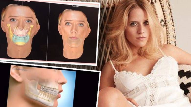 Jessica Mercedes będzie miała łamaną szczękę