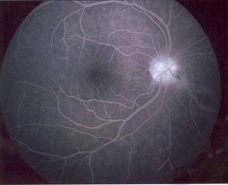 Obraz siatkówki oka