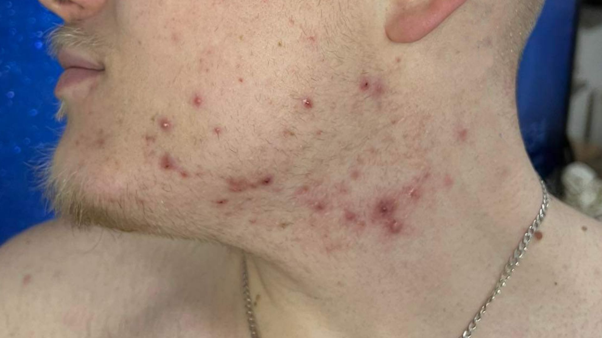 Niektóre produkty spożywcze zaostrzają stany zapalne, zwiększają produkcję sebum i przyczyniają się do powstawania wyprysków.