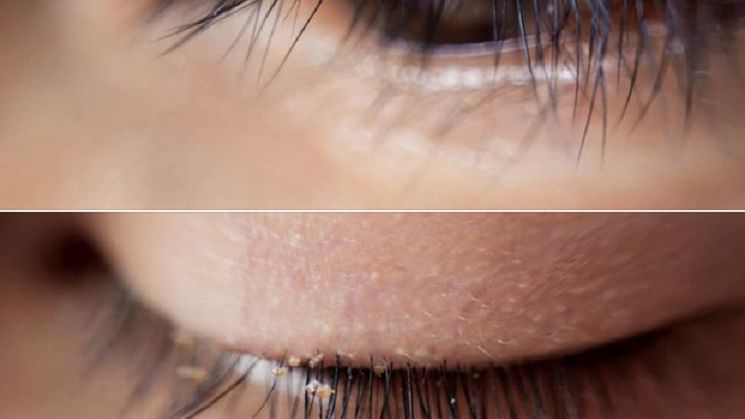 Wszy atakują rzęsy