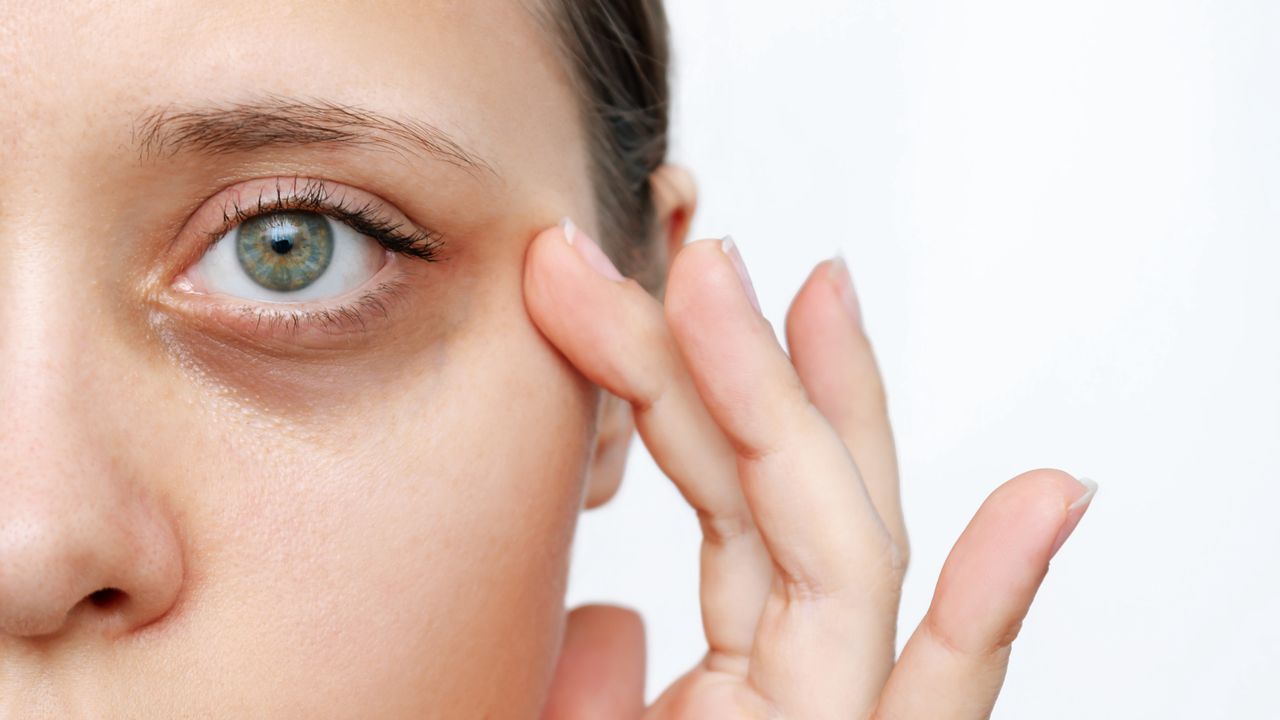 How to remove dark circles under the eyes?