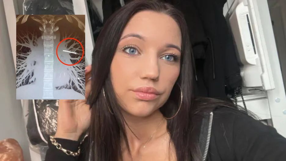 29-latka chciała usunąć implant antykoncepcyjny. Prześwietlenie ujawniło straszną prawdę