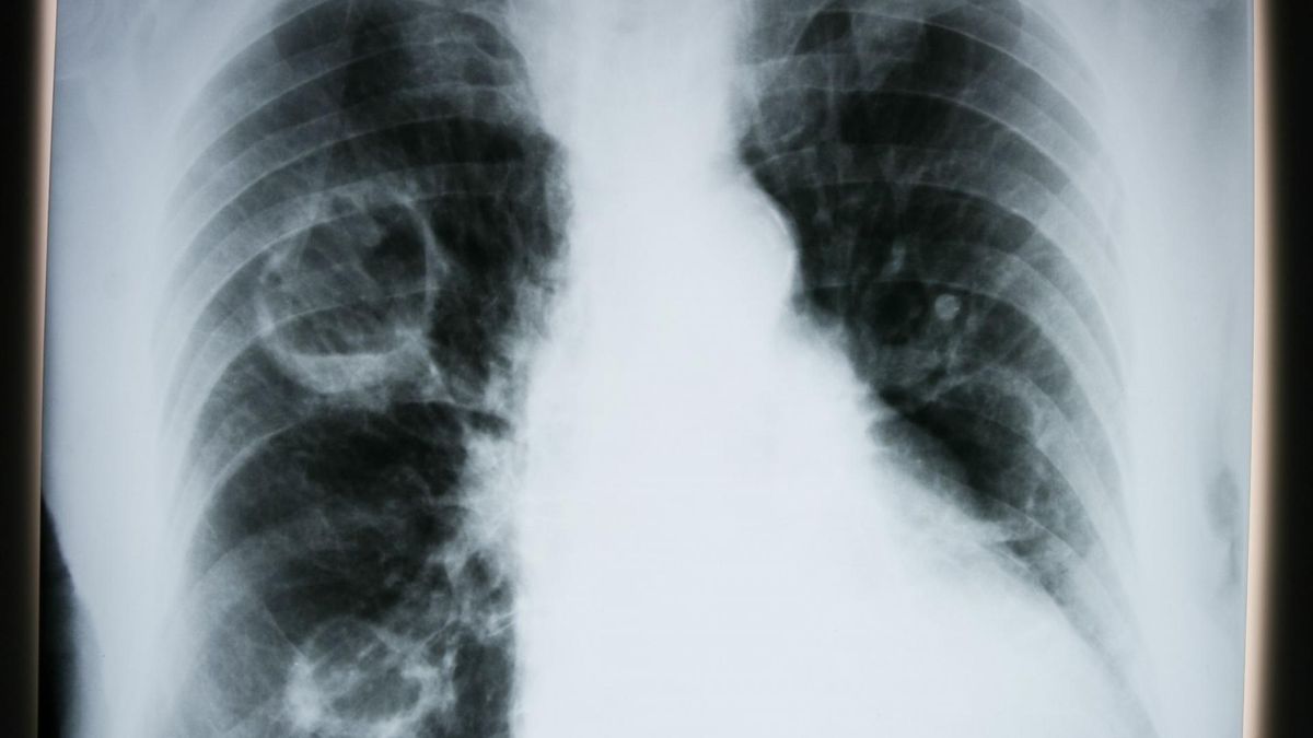 Lekarz wyjaśnia, jak koronawirus niszczy płuca. Zmiany występują nawet u pacjentów, którzy ozdrowieli