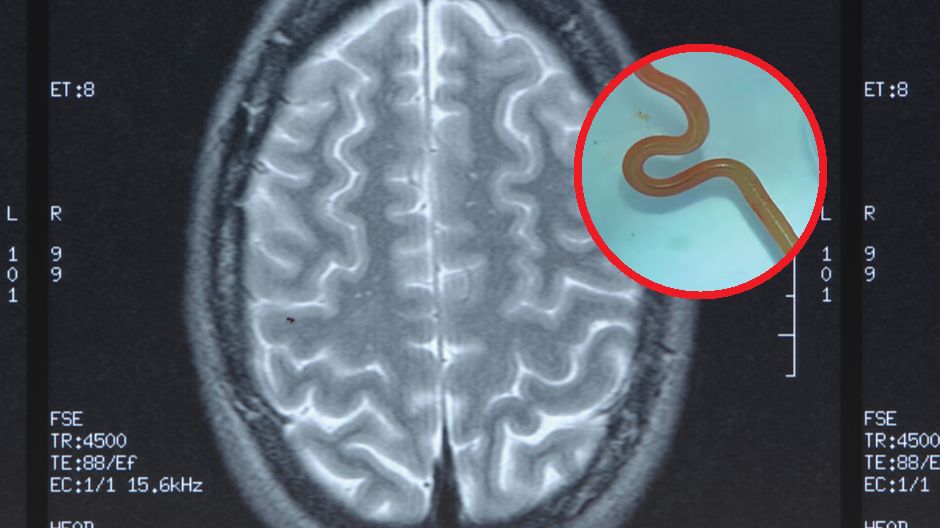 Pierwszy taki przypadek na świecie. Znaleziony w mózgu pasożyt miał 8 cm