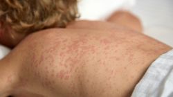 Mastocytoza skórna - co to jest, objawy, przyczyny, leczenie