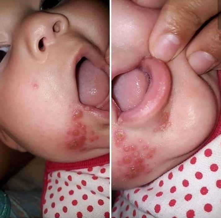 Niemowlę zaraziło się opryszczką
