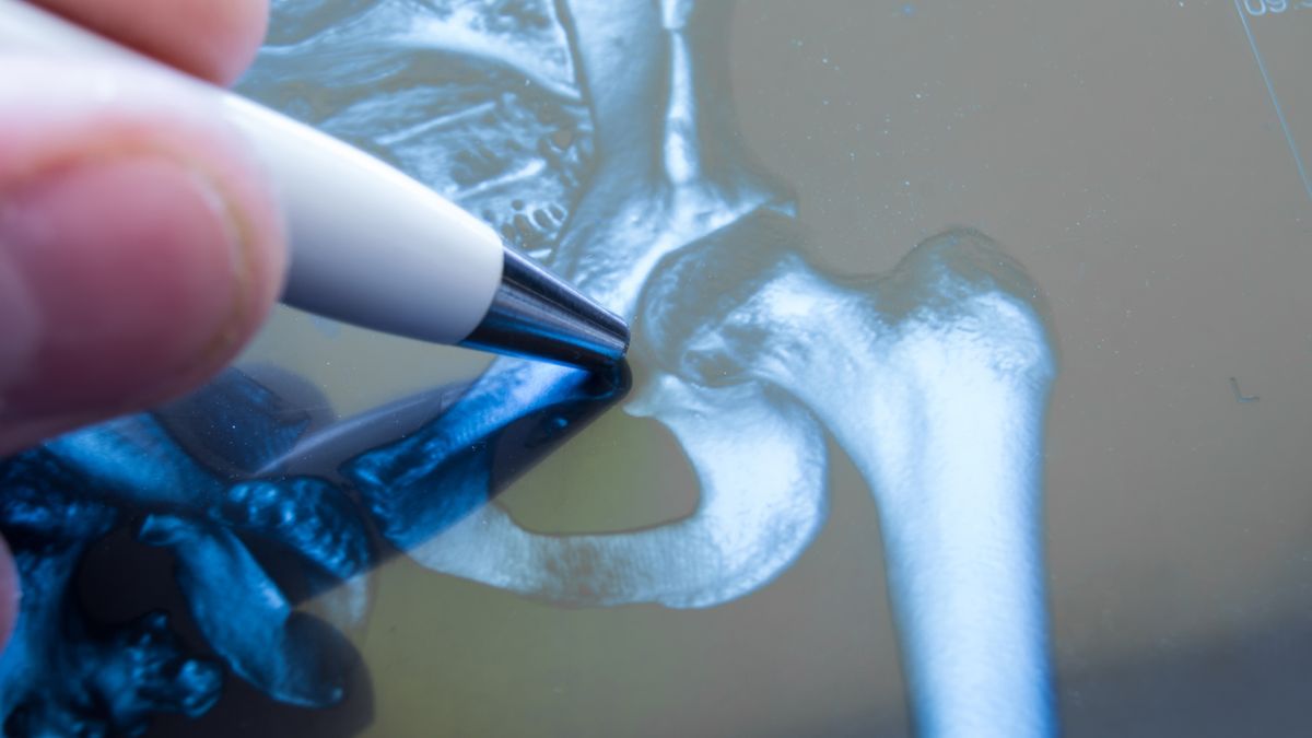 Zwyrodnienie stawu biodrowego znane również pod nazwą koksartroza, oznacza stopniowe i nieodwracalne niszczenie chrząstki stawowej i innych tkanek, które tworzą staw.