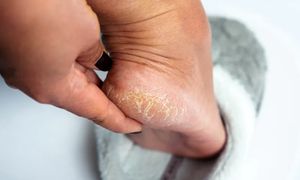 Kosztuje 15 zł. Hit z apteki na suche pięty