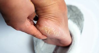 Hit z apteki na suche pięty. Kosztuje 15 zł