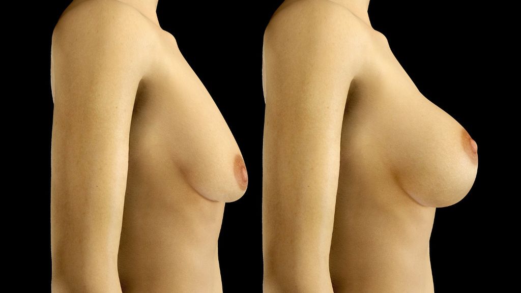 piersi po operacji