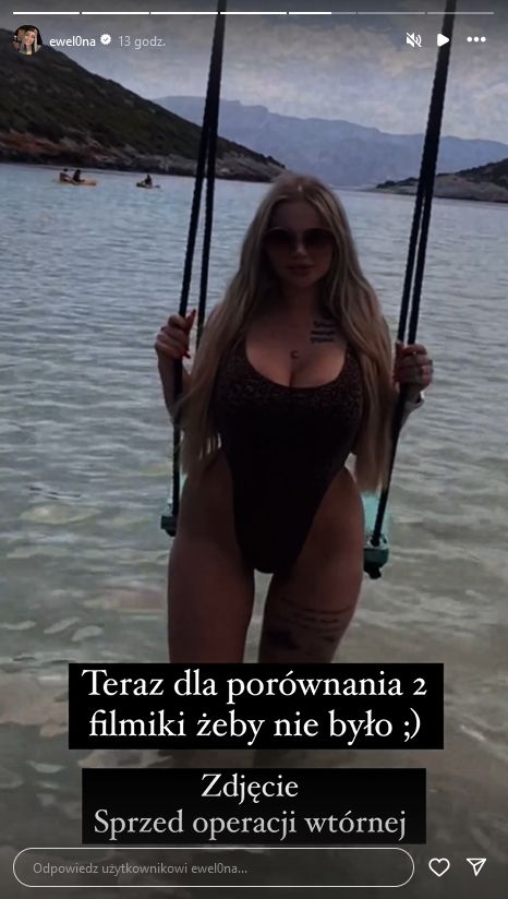 Ewel0na zachwyca się efektami ostatniej operacji plastycznej 