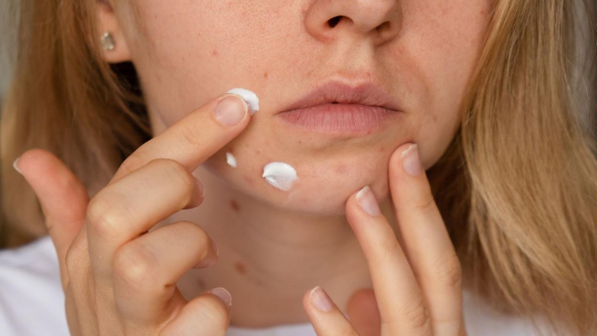 Trądzik jest to przewlekła skóry, która jest powodowana nadmierną aktywnością gruczołów łojowych oraz mieszków włosowych.