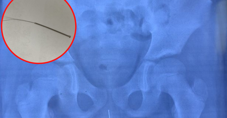 11-latek nie mógł oddać moczu. Wyniki zdjęcia RTG zszokowały nawet lekarzy
