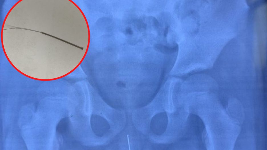 Badanie obrazowe ujawniło ciało obce w drogach moczowych nastolatka