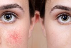 Rosacea – podstępna choroba, która męczy Polki