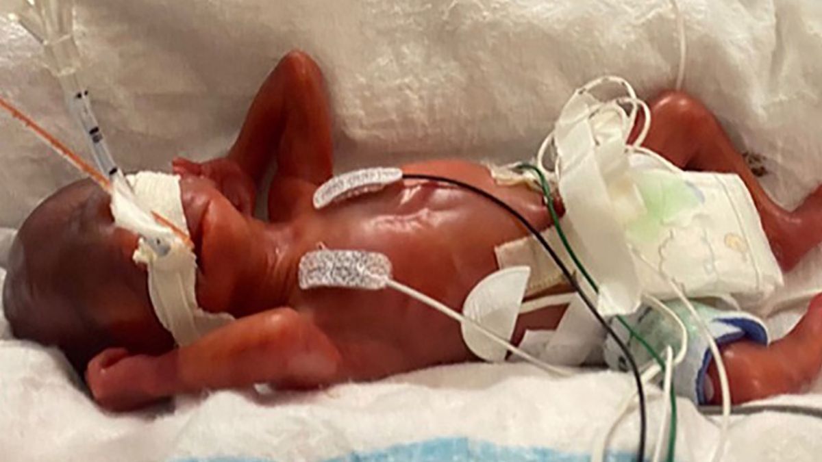 Curtis Means urodził się w 21. tygodniu ciąży