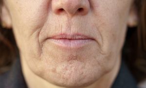 Skóra szybko się napnie. Popularny sposób na "zmarszczki palacza"