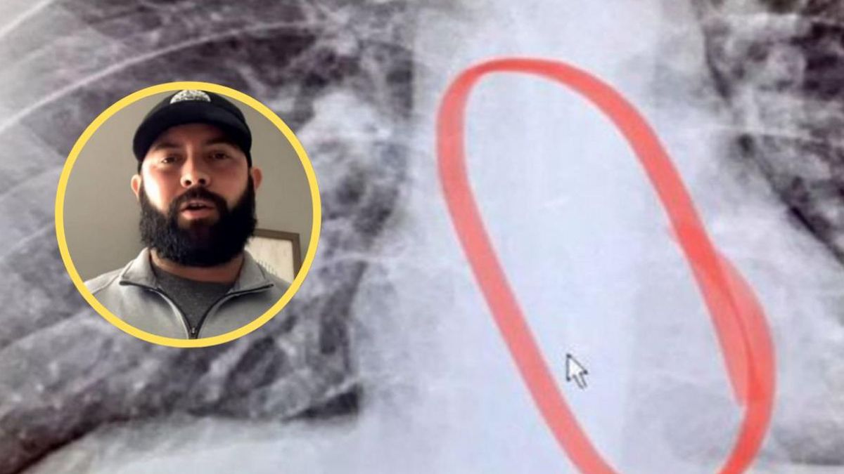 Brad Gauthier i jego zdjęcie rentgenowskie.