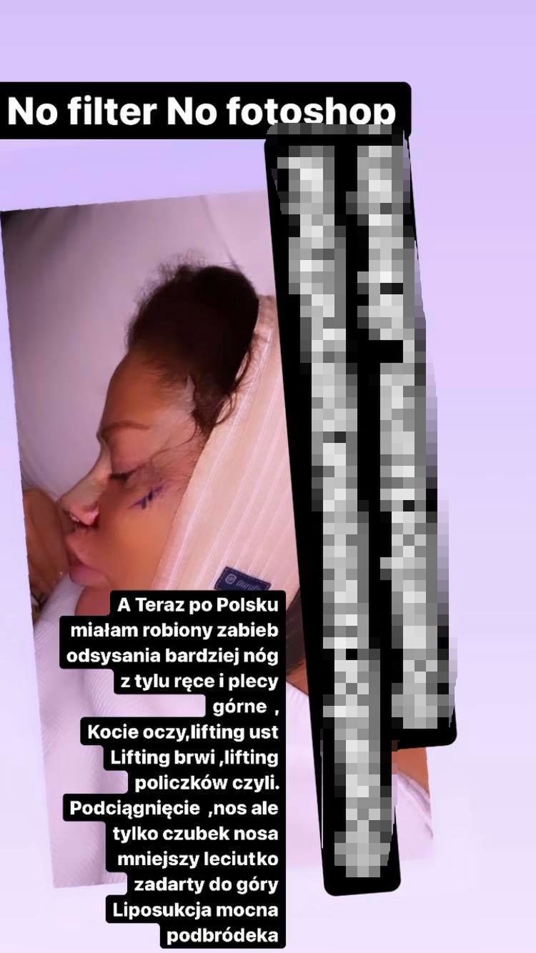 Laluna Unique  z "Królowych Życia" chwali się odsysaniem tłuszczu w tureckiej klinice