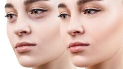 Podkrążone oczy - przyczyny, objawy i leczenie