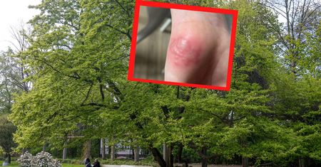 Chłopiec był z babcią w parku. Nagle spuchła mu ręka