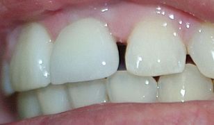Jak zlikwidować szparę między zębami?